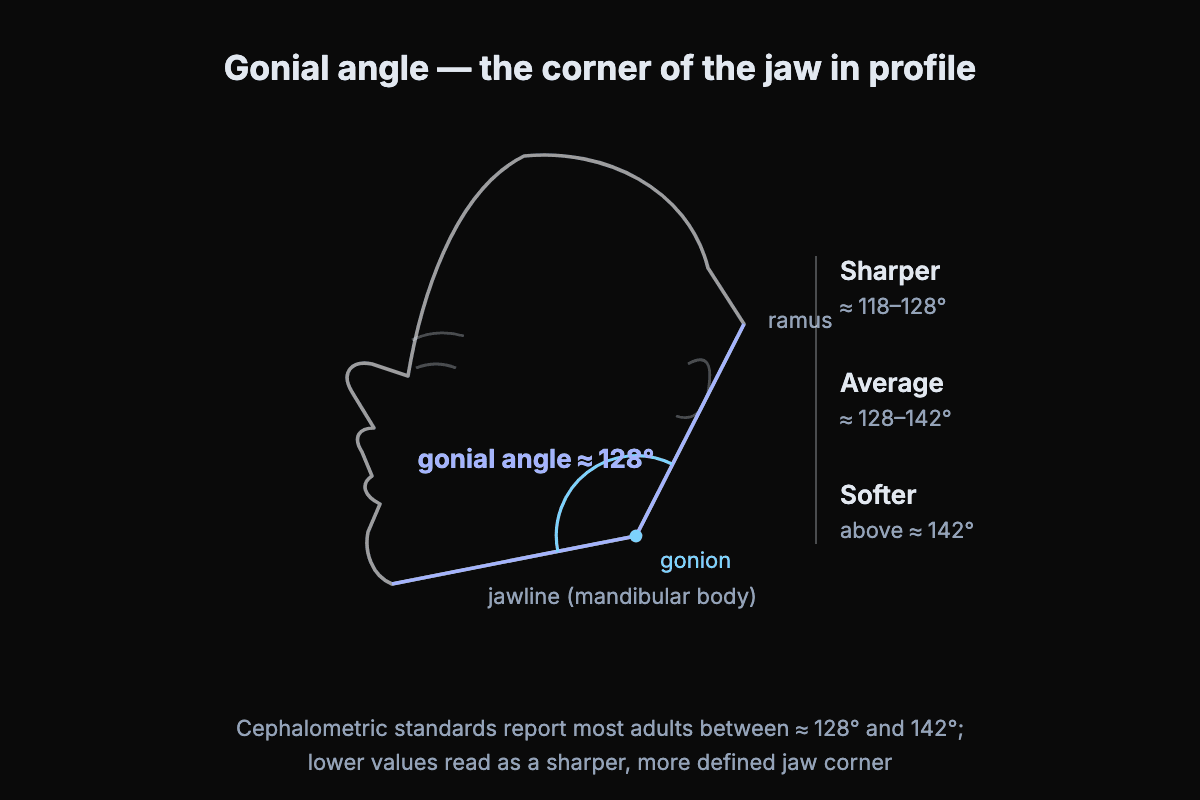 Diagram of the gonial angle on a side profile: the jawline angle measured at the gonion between the ramus and the mandibular body, with sharper, average and softer degree ranges